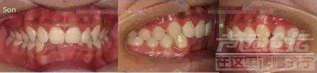 很多人都有！牙齿的深覆合需要重视-济宁丁香树口腔-4.jpg