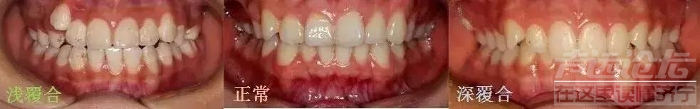 很多人都有！牙齿的深覆合需要重视-济宁丁香树口腔-2.jpg