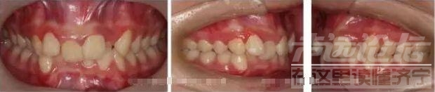 很多人都有！牙齿的深覆合需要重视-济宁丁香树口腔-9.jpg