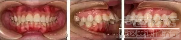 很多人都有！牙齿的深覆合需要重视-济宁丁香树口腔-11.jpg