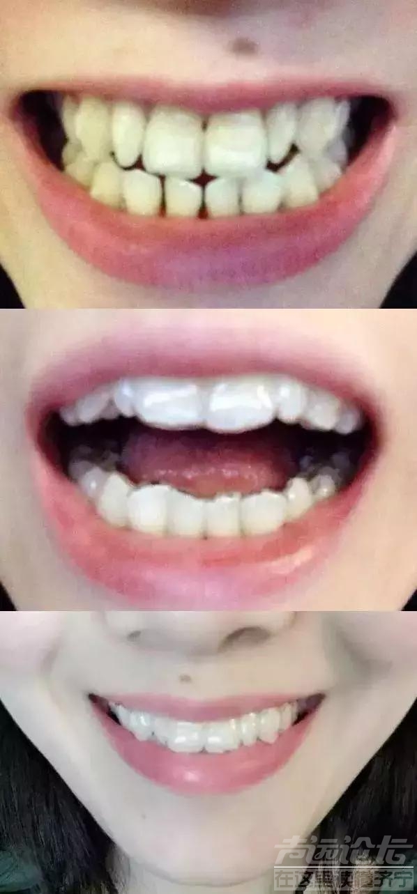 一个小小的塑料牙套也能矫正牙齿？-1.jpg