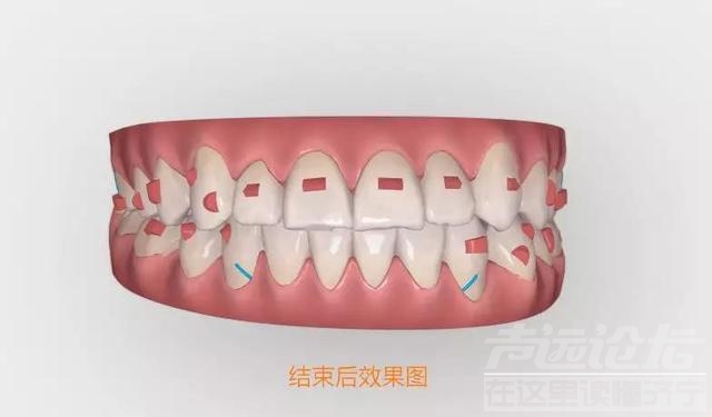关于隐形矫正，你不知道的事情-4.jpg