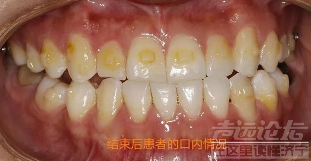 关于隐形矫正，你不知道的事情-5.jpg