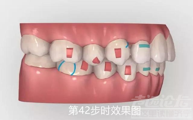 关于隐形矫正，你不知道的事情-6.jpg