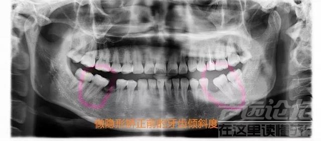 关于隐形矫正，你不知道的事情-10.jpg
