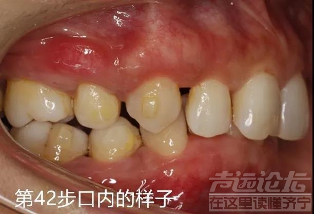 关于隐形矫正，你不知道的事情-7.jpg
