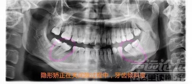 关于隐形矫正，你不知道的事情-11.jpg