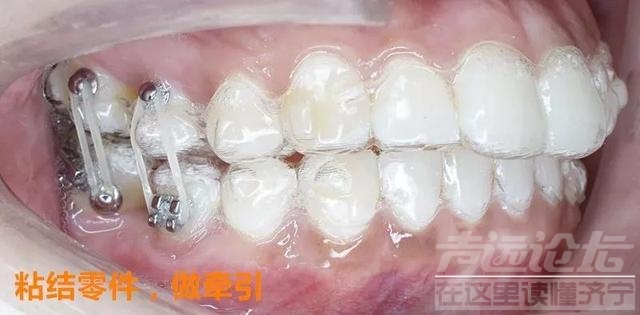 关于隐形矫正，你不知道的事情-13.jpg