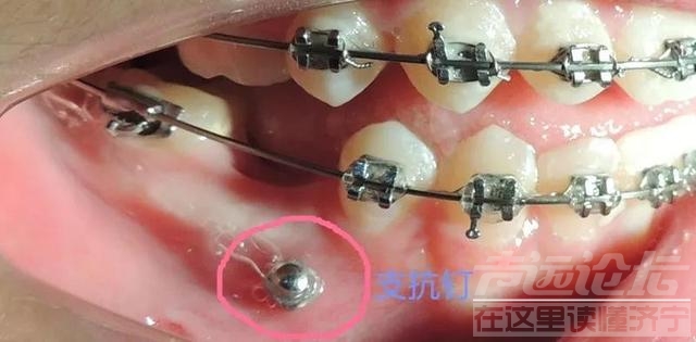关于隐形矫正，你不知道的事情-18.jpg
