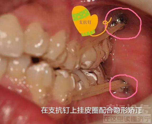 关于隐形矫正，你不知道的事情-17.jpg