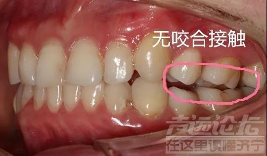 关于隐形矫正，你不知道的事情-14.jpg