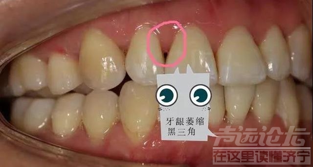 关于隐形矫正，你不知道的事情-16.jpg