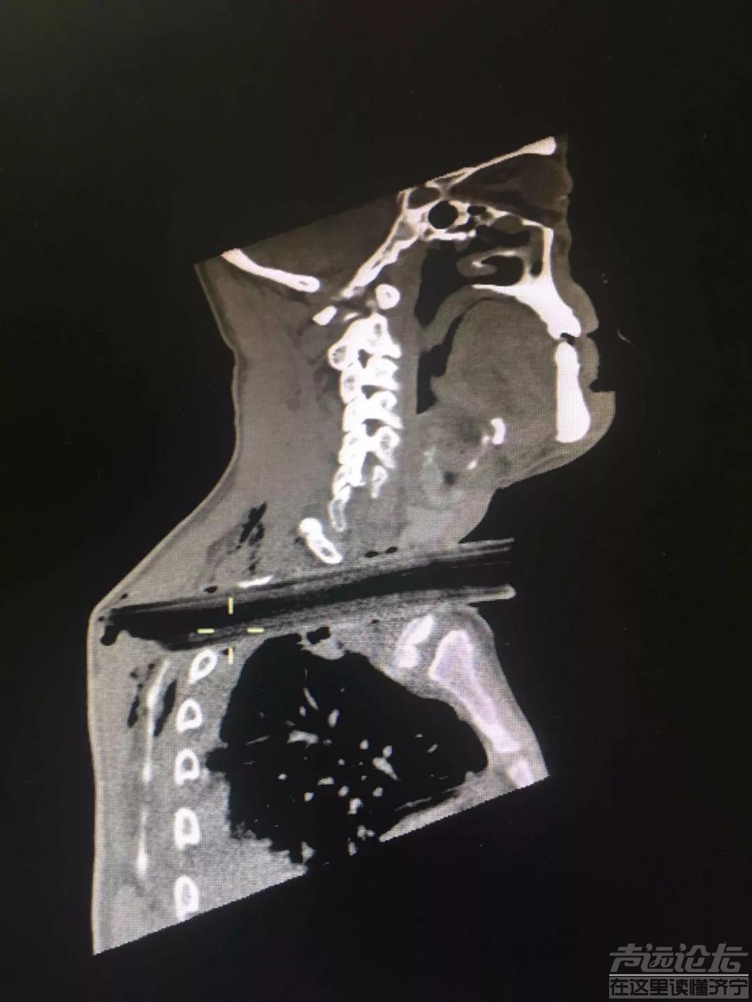 兖州一男子被20厘米长的树枝横穿颈部 经10小时手术成功脱险-1.jpg