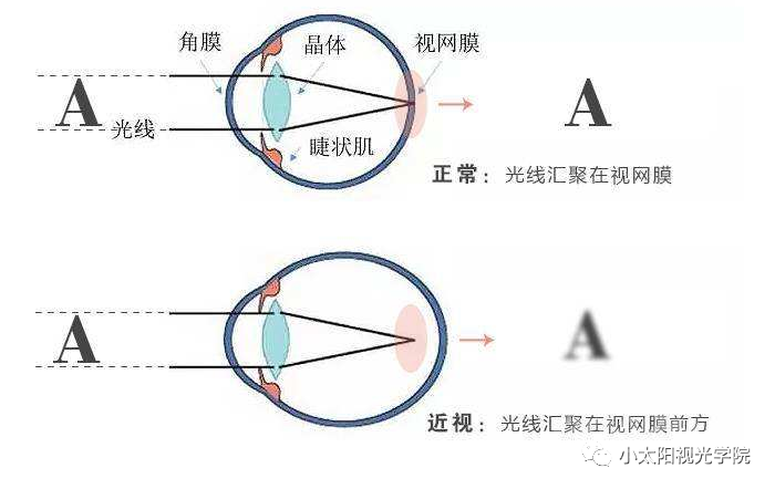 近视认识误区-1.jpg