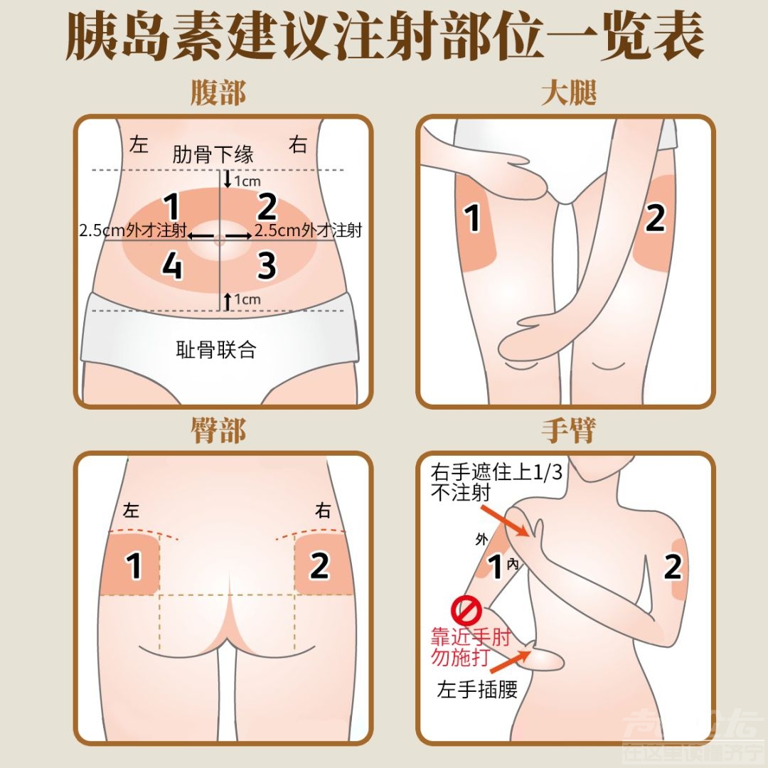 注射胰岛素正确方法-3.jpg