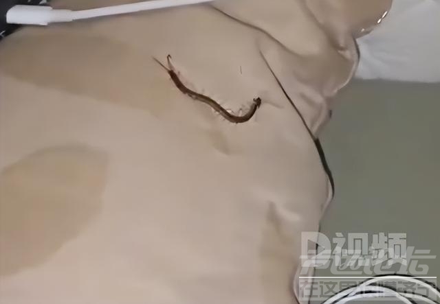 女子睡觉被10厘米蜈蚣咬太阳穴：被疼醒了脸都是肿的，4天内被2条蜈蚣咬了3个伤口-1.jpg