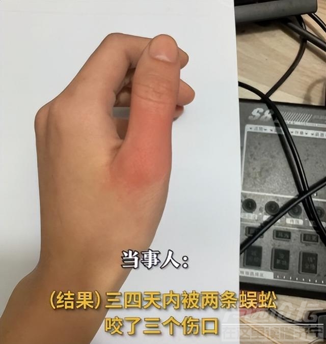 女子睡觉被10厘米蜈蚣咬太阳穴：被疼醒了脸都是肿的，4天内被2条蜈蚣咬了3个伤口-3.jpg