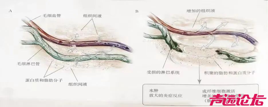 济宁市第一人民医院在鲁西南率先开展上肢淋巴静脉吻合术，为复杂性上肢水肿患者带来治-2.jpg