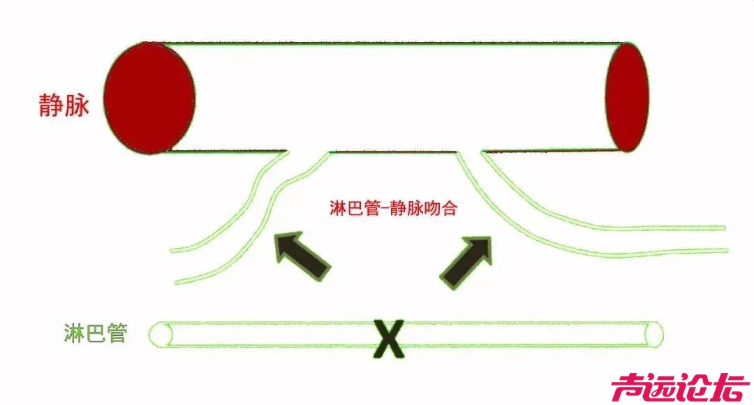 济宁市第一人民医院在鲁西南率先开展上肢淋巴静脉吻合术，为复杂性上肢水肿患者带来治-3.jpg