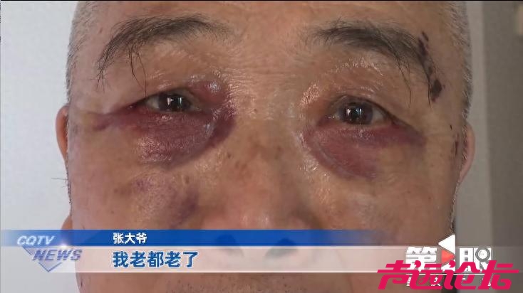 七旬大爷出门散步被拉去割眼袋，女儿赶到时大爷已出手术室：血从眼角浸出，眼睛都肿了-1.jpg