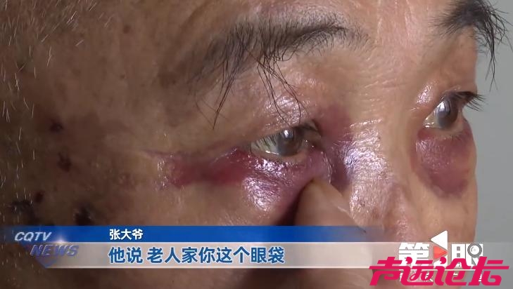 七旬大爷出门散步被拉去割眼袋，女儿赶到时大爷已出手术室：血从眼角浸出，眼睛都肿了-2.jpg