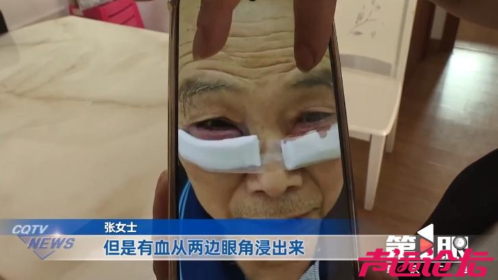 七旬大爷出门散步被拉去割眼袋，女儿赶到时大爷已出手术室：血从眼角浸出，眼睛都肿了-3.jpg