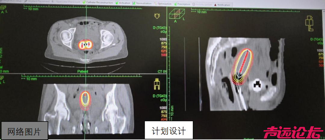 济宁市第一人民医院启用国际先进后装放疗系统，鲁西南医疗高地再添抗癌新利器-4.jpg