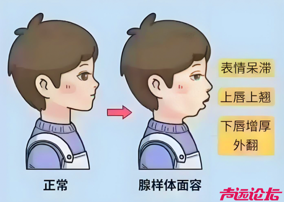 暑假“腺”计划 :“呼噜娃”救星 微创手术解难题-1.jpg