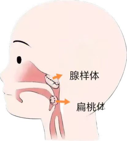 暑假“腺”计划 :“呼噜娃”救星 微创手术解难题-2.jpg