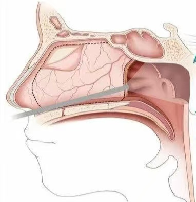 暑假“腺”计划 :“呼噜娃”救星 微创手术解难题-3.jpg