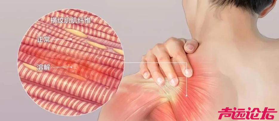 【一院科普】警惕过量运动后的隐形杀手——横纹肌溶解综合征-2.jpg