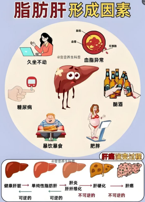 【一院科普】代谢性脂肪性肝病——沉默的肝脏危机，你要知道-1.jpg