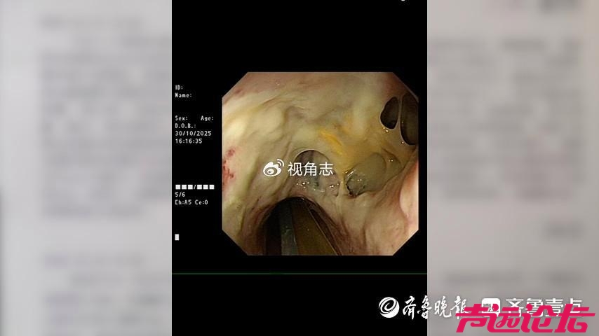 术后食道穿孔，梁山一女士胸腔、纵隔被感染-3.jpg