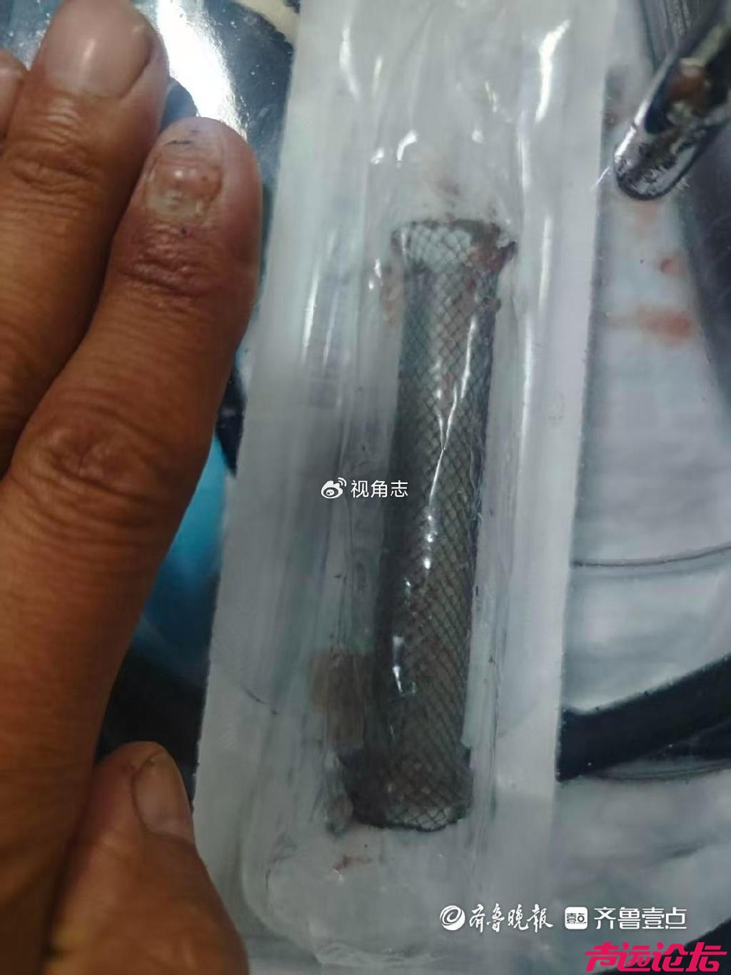 术后食道穿孔，梁山一女士胸腔、纵隔被感染-5.jpg