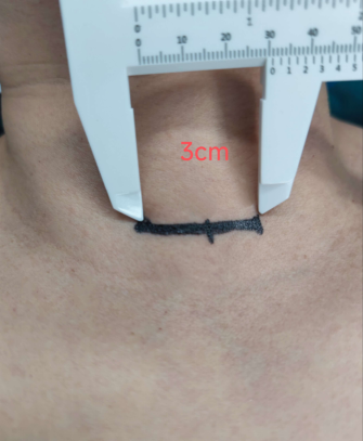 微创无引流 次日即出院--济宁市第一人民医院精细化甲状腺癌手术实现诊疗新突破-2.jpg