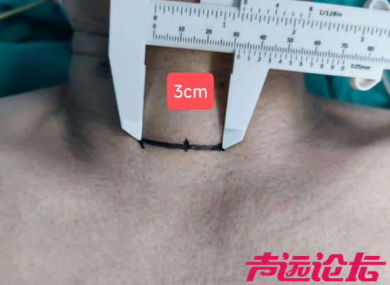 微创无引流 次日即出院--济宁市第一人民医院精细化甲状腺癌手术实现诊疗新突破-3.jpg