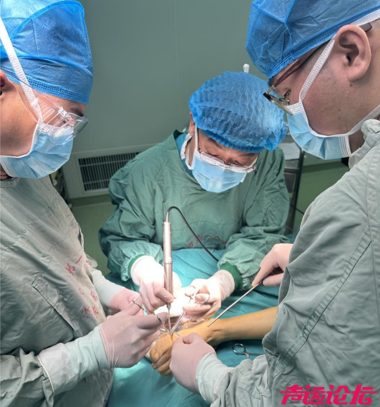 突破技术壁垒 守护足部健康--济宁市第一人民医院成功开展微创拇外翻矫正术-1.jpg