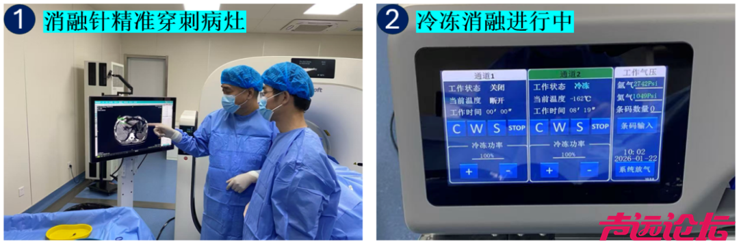 一根针“冻死”肿瘤，这种技术您了解吗-1.jpg