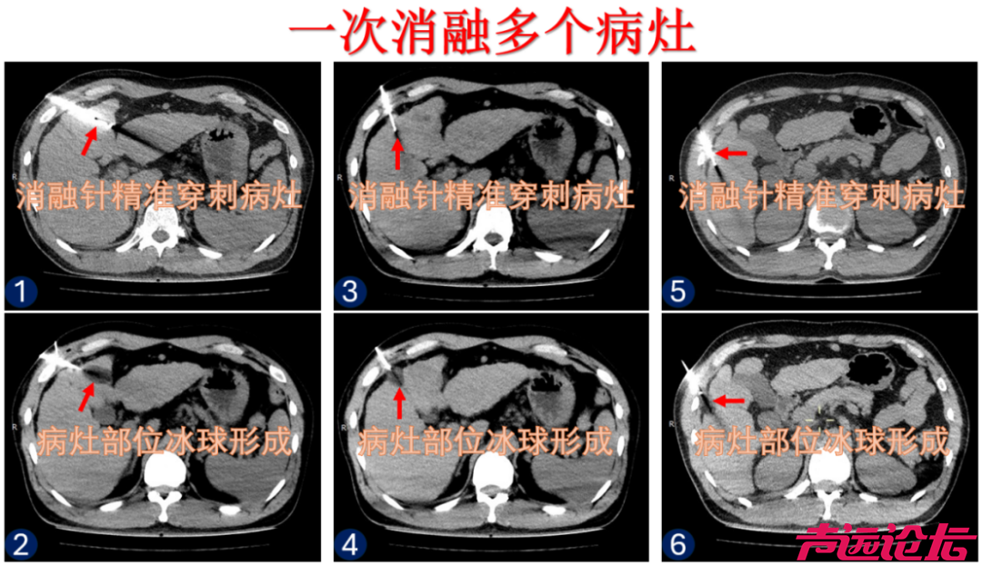 一根针“冻死”肿瘤，这种技术您了解吗-2.jpg