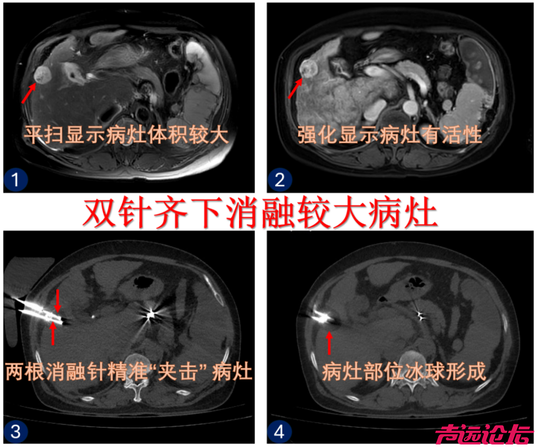 一根针“冻死”肿瘤，这种技术您了解吗-3.jpg