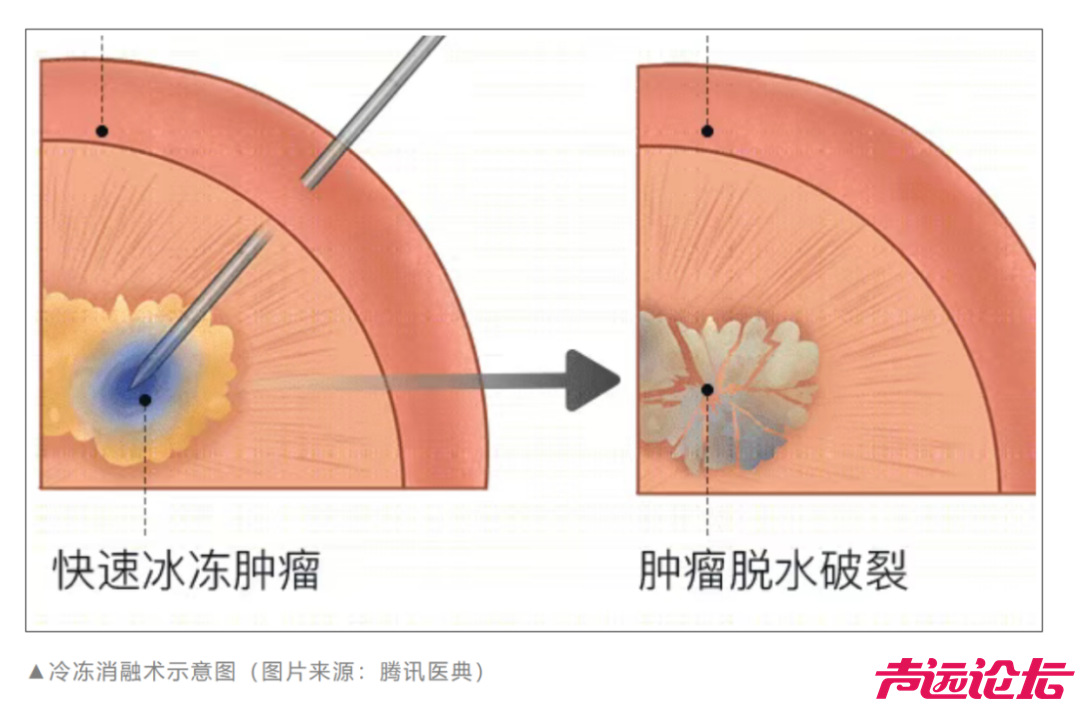 一根针“冻死”肿瘤，这种技术您了解吗-4.jpg