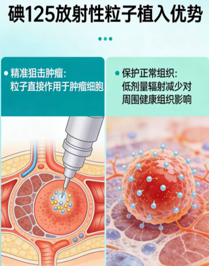 济宁市第一人民医院成功开展首例碘125放射性粒子植入术，精准“布雷”剿灭肿瘤-2.jpg