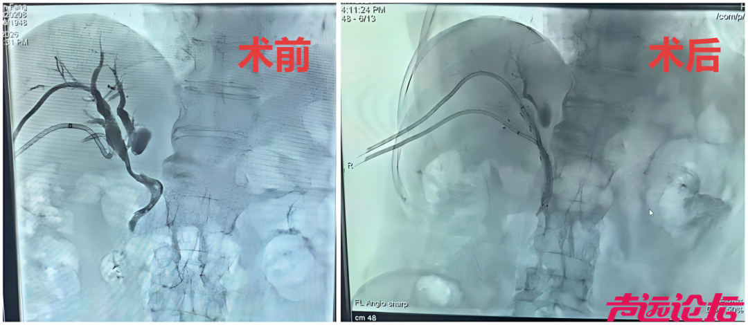 济宁市第一人民医院成功开展鲁西南首例自膨式可载粒子胆道支架植入术-2.jpg