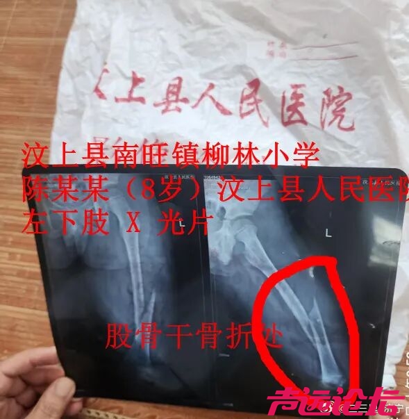 济宁小学老师脚踢8岁学生致骨折-1.jpg