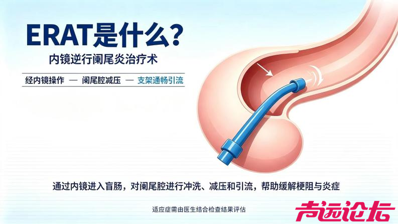 内镜下精准“疏通”，保住阑尾不开刀-1.jpg